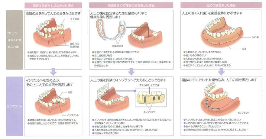 インプラント04