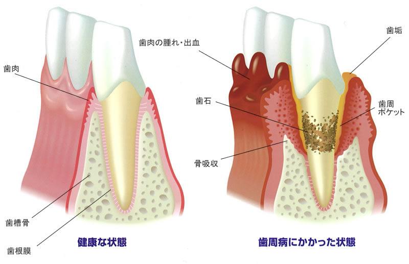 歯周病